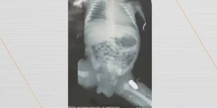 Adolescente grávida de 9 meses leva tiro e bala fica alojada na perna do bebê